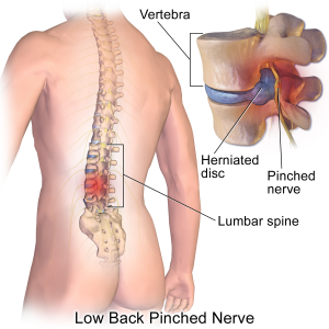 disc herniation