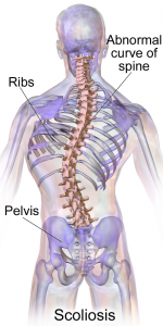 scoliosis